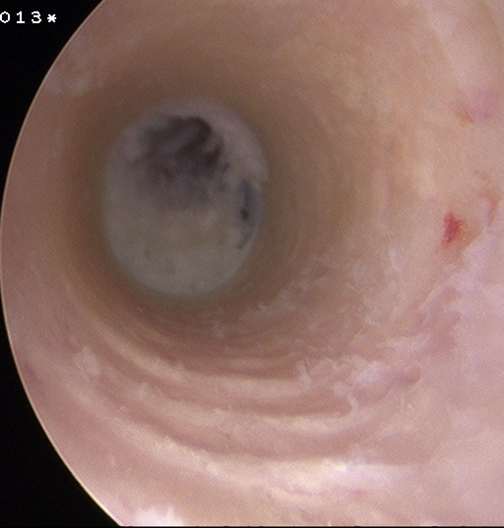 Tibial Tunnel Debrided